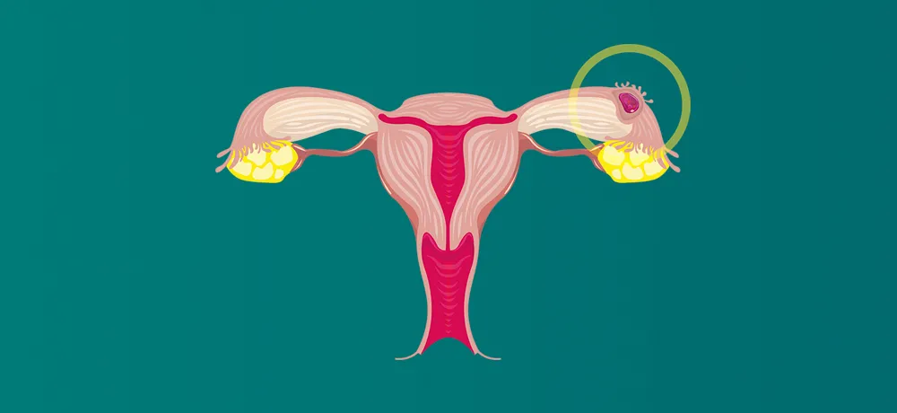 Чи покаже тест позаматкову вагітність?